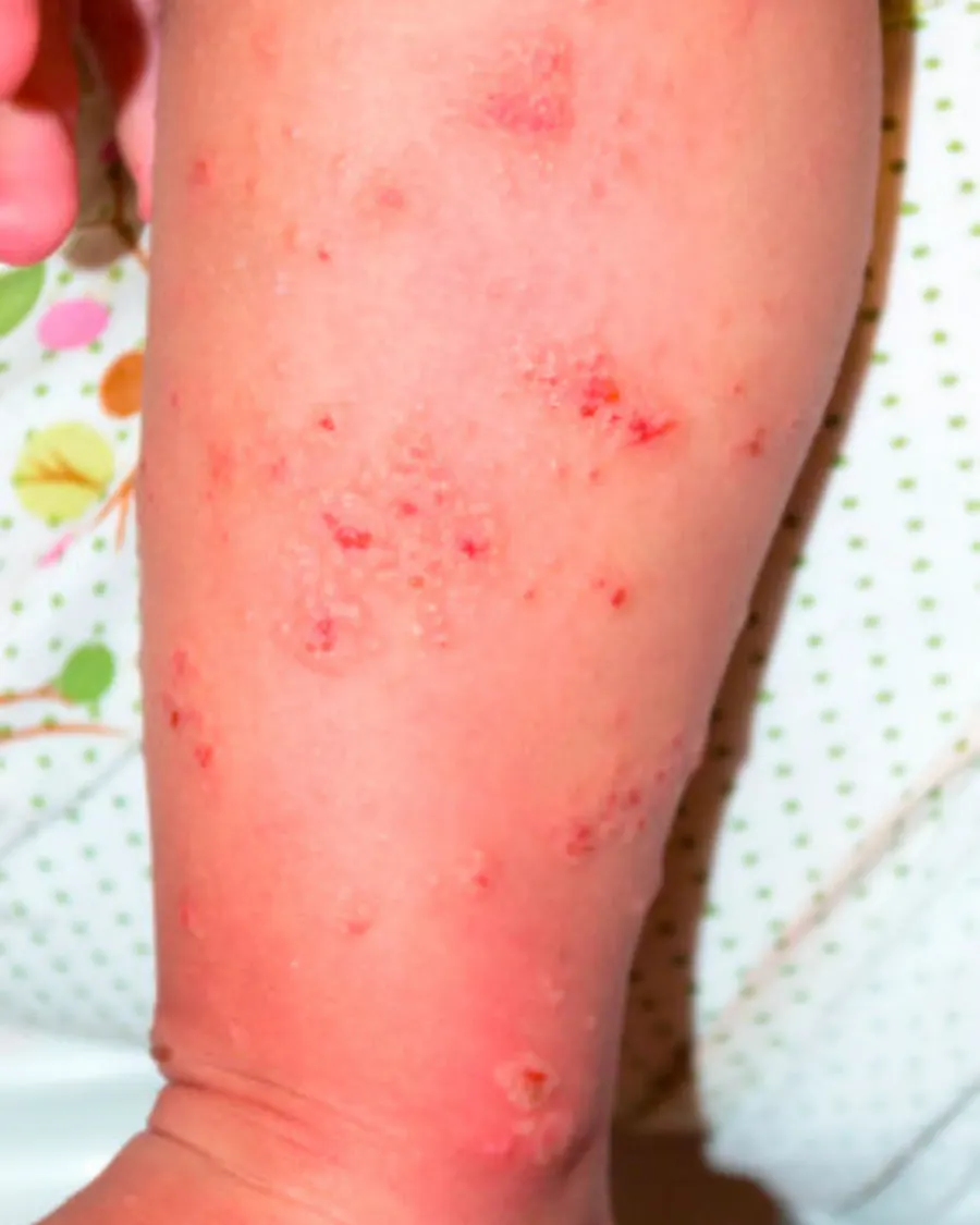 Fungal infections at Cinch Clinics
